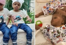 AI தொழில்நுட்பத்தின் உதவியால் தலைப்பகுதியில் இணைந்திருந்த இரட்டைச் சகோதரிகள் வெற்றிகரமாகப் பிரிப்பு