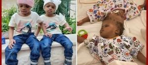 AI தொழில்நுட்பத்தின் உதவியால் தலைப்பகுதியில் இணைந்திருந்த இரட்டைச் சகோதரிகள் வெற்றிகரமாகப் பிரிப்பு